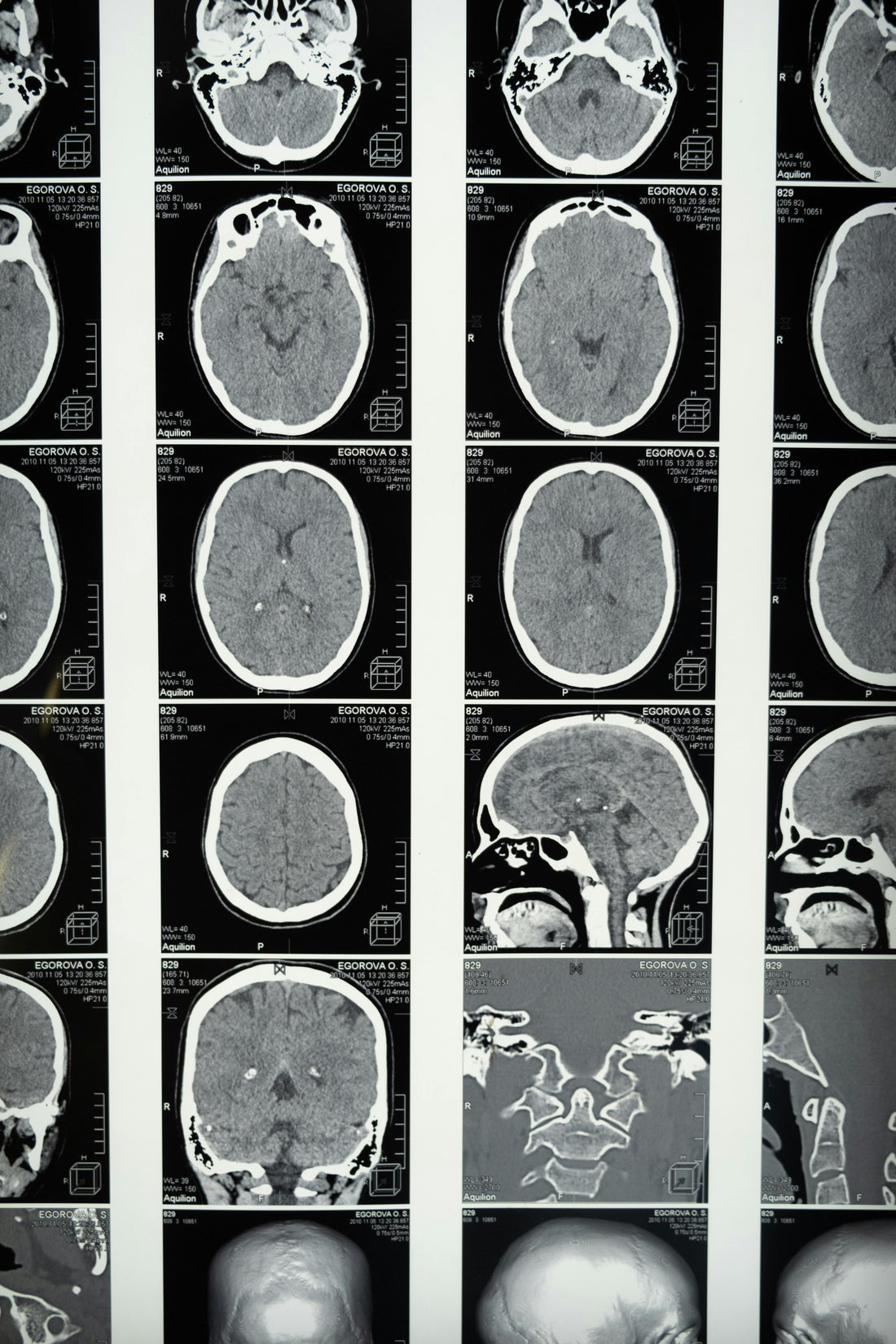 CBD para epilepsia, Parkinson y esclerosis múltiple: beneficios en trastornos neurológicos