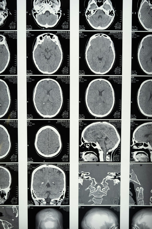 CBD para epilepsia, Parkinson y esclerosis múltiple: beneficios en trastornos neurológicos